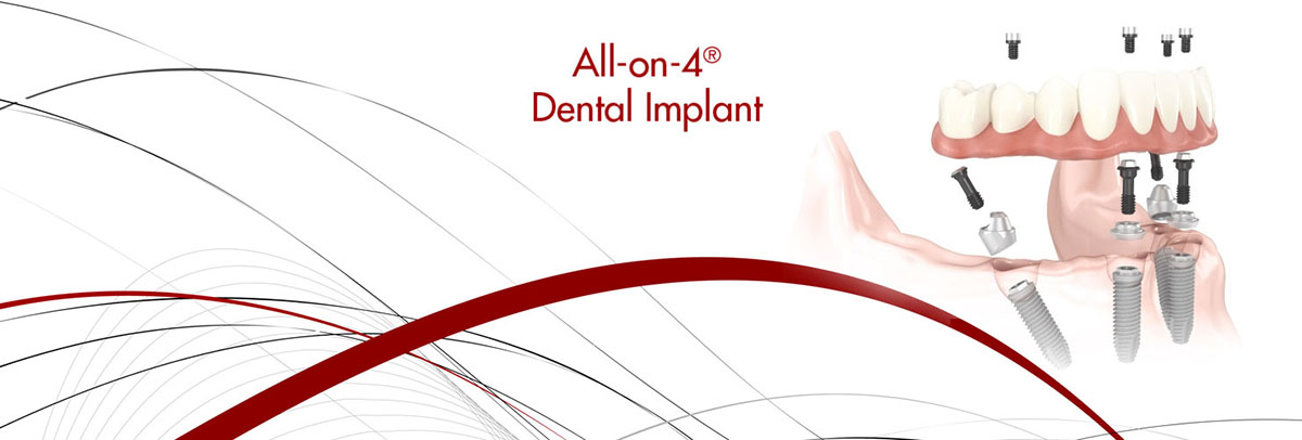 Placentia All-on-4 Dental Implants