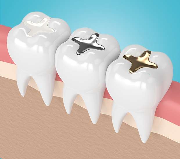 Placentia Composite Fillings