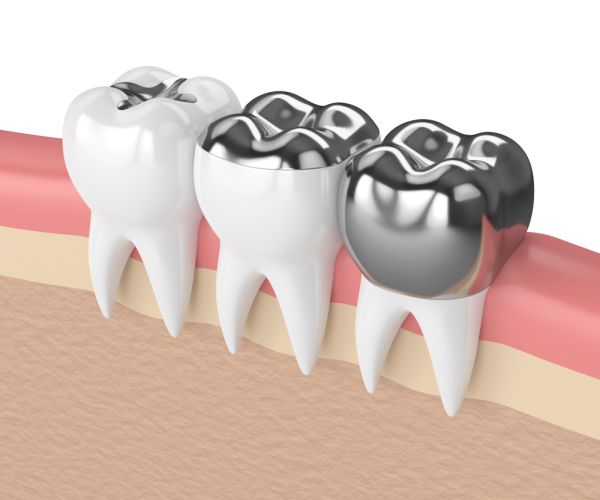 How Important Is Dental Crown Material Choice?