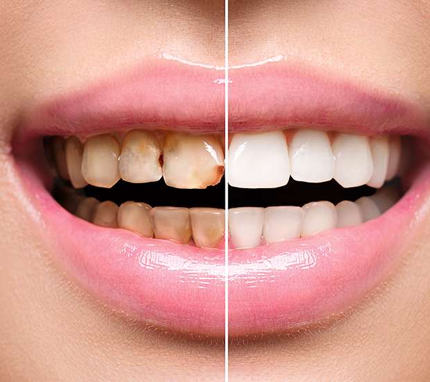 Placentia Dental Implant Restoration