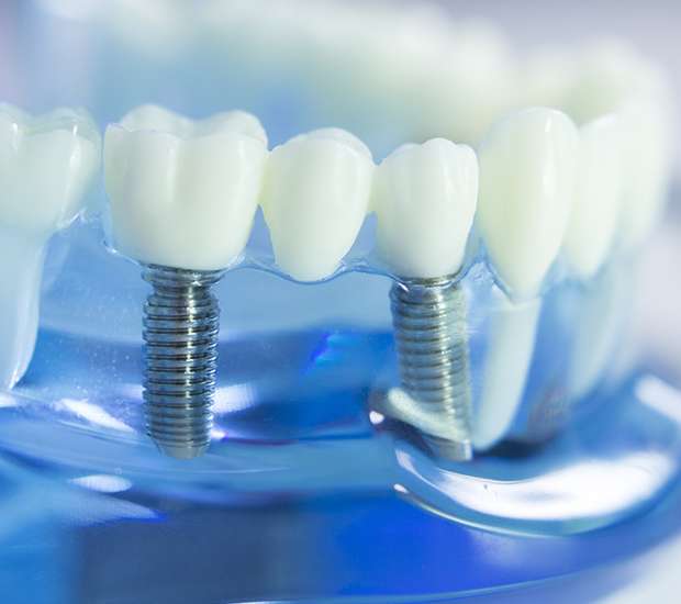 Placentia Dental Implants