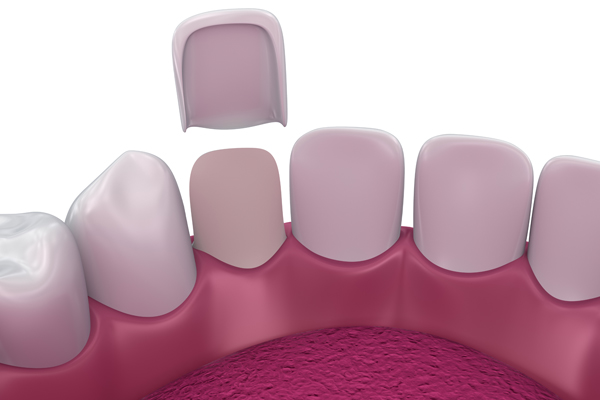 Signs That It Is Time To Replace Your Dental Veneers