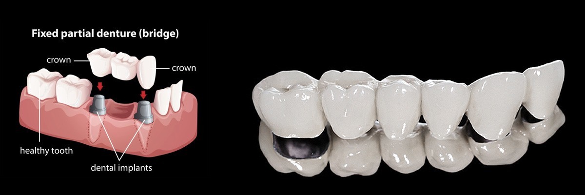 Placentia Dentures