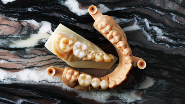 Dental Implant Restorations: How To Maintain Your New Smile