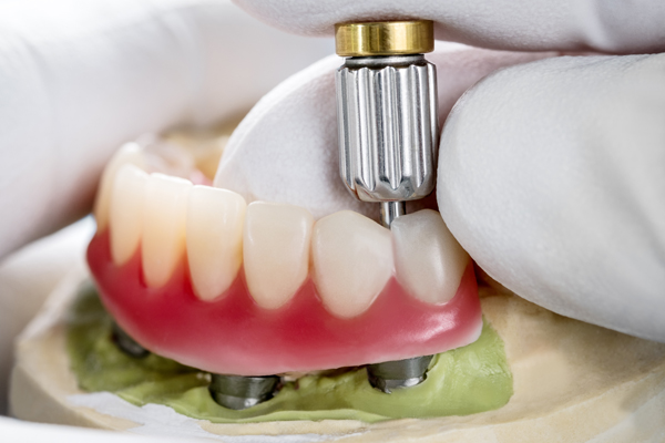 When To Consider Implant Supported Dentures Over Traditional Dentures