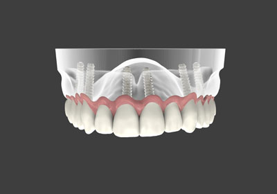 What Are Implant Supported Dentures?