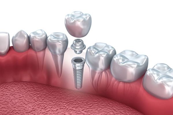 Mini Dental Implants