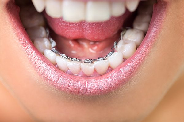 Adult Braces