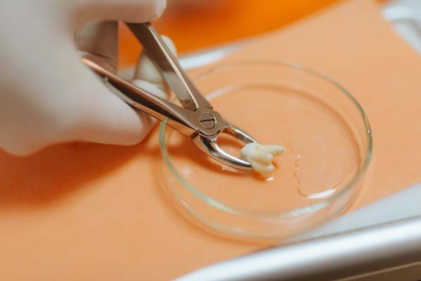 A Step By Step Guide To A Tooth Extraction Procedure