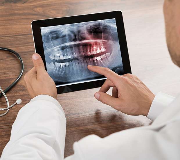 Placentia Types of Dental Root Fractures